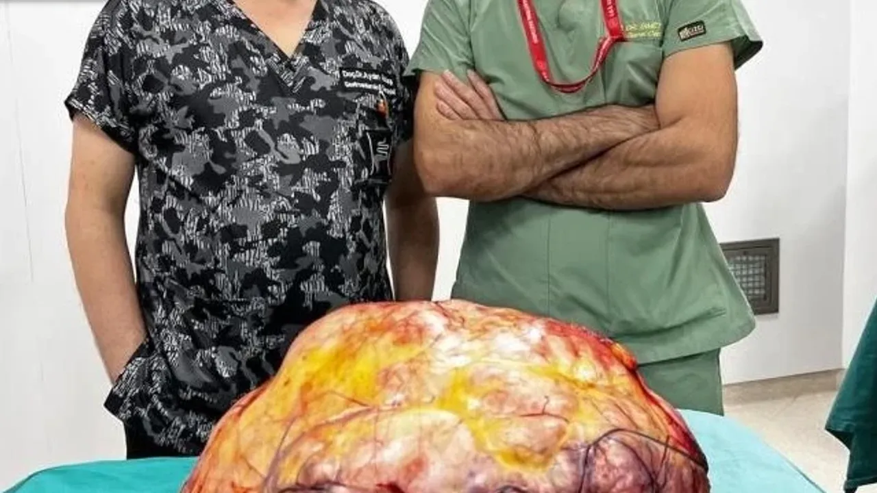 Trabzon’da Karın Ağrısı Şikayetiyle Gittiği Hastanede 26 Kiloluk Tümör Çıkarıldı