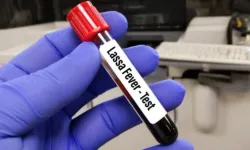 Lassa ateşi salgınında kaç kişi öldü? Lassa ateşi salgını nedir, bulaşıcı mı, belirtileri neler, Türkiye'ye geldi mi?