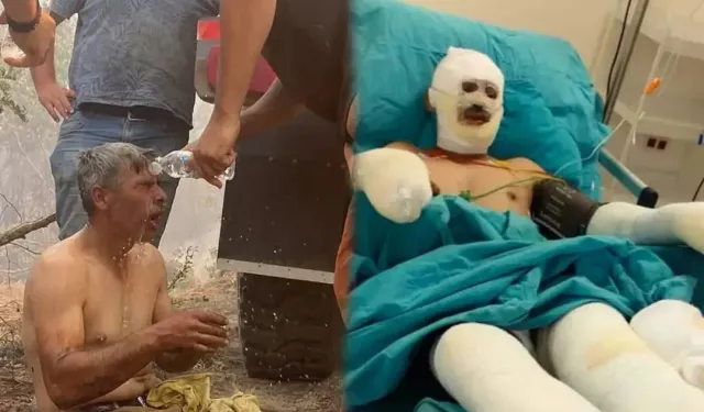 “Yanıyorum, Su Verin” Diye Feryat Eden Orman İşçisinin Son Hali Paylaşıldı