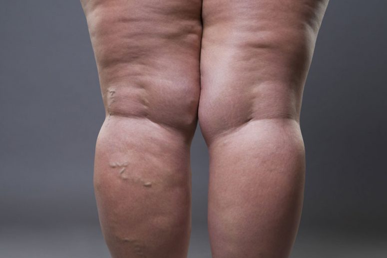 Uzmanı Uyardı Lipodem Hastaları Bu Gıdalardan Uzak Durmalı! (3)