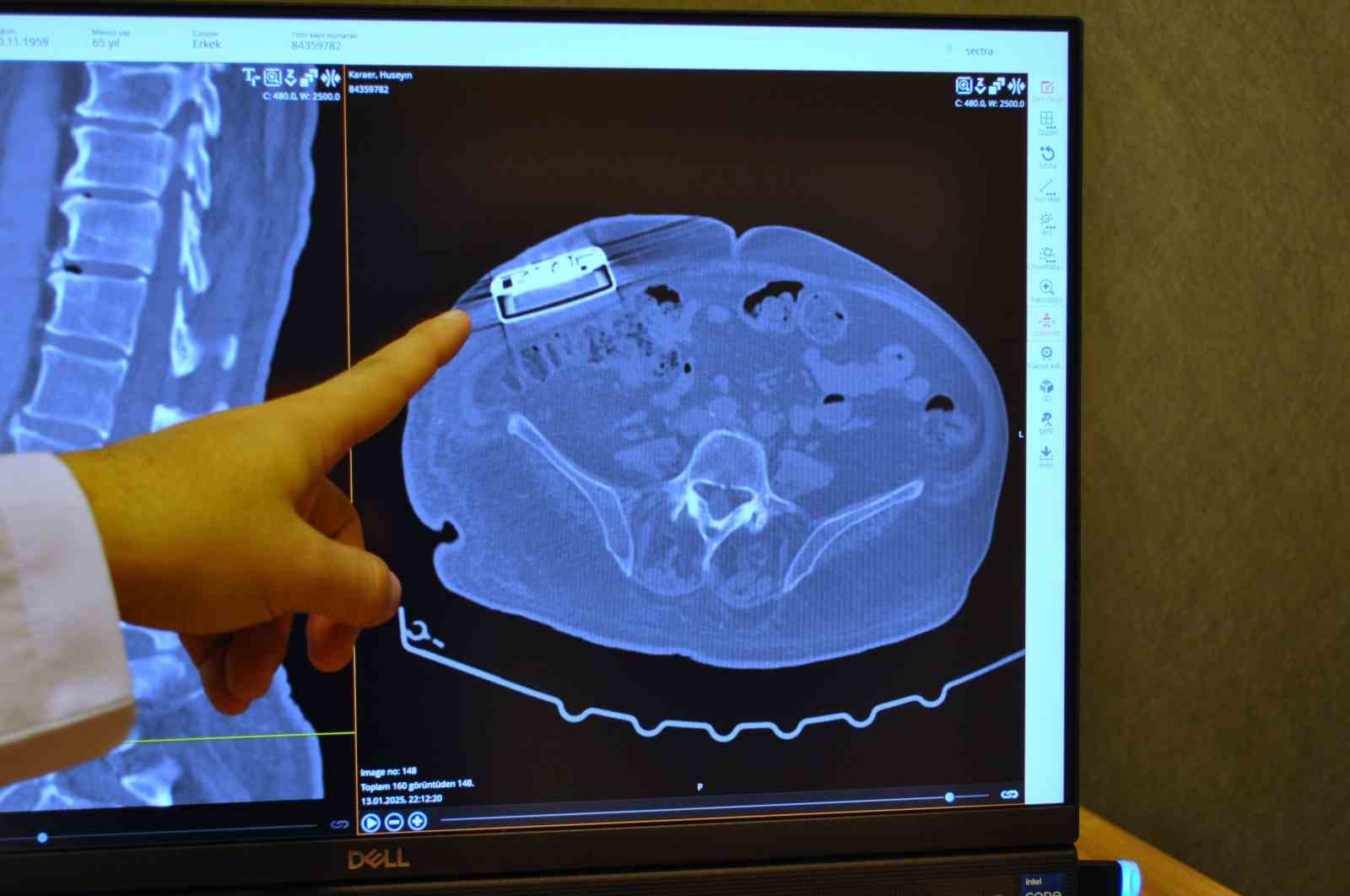 ozel-gelismis-teknoloji-yeni-versiyon-baklofen-pompasi-turkiyede-ilk-defa-eskisehirde-implante-edildi