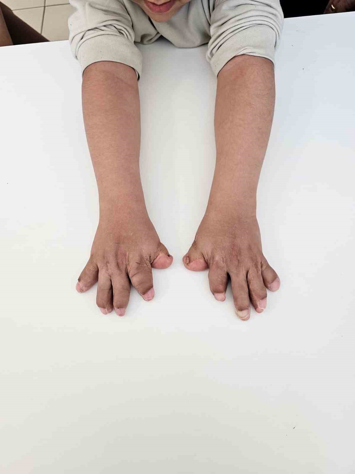 doktorlarin-ismini-yeni-duydugu-rahatsizlik-eskisehirde-tedavi-edildi-10-parmagi-acildi