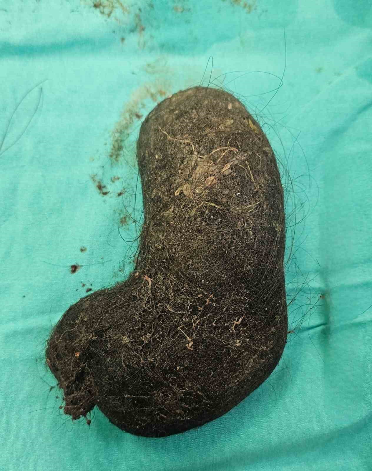 minik-kizin-midesinden-devasa-bir-sac-yumagi-cikti