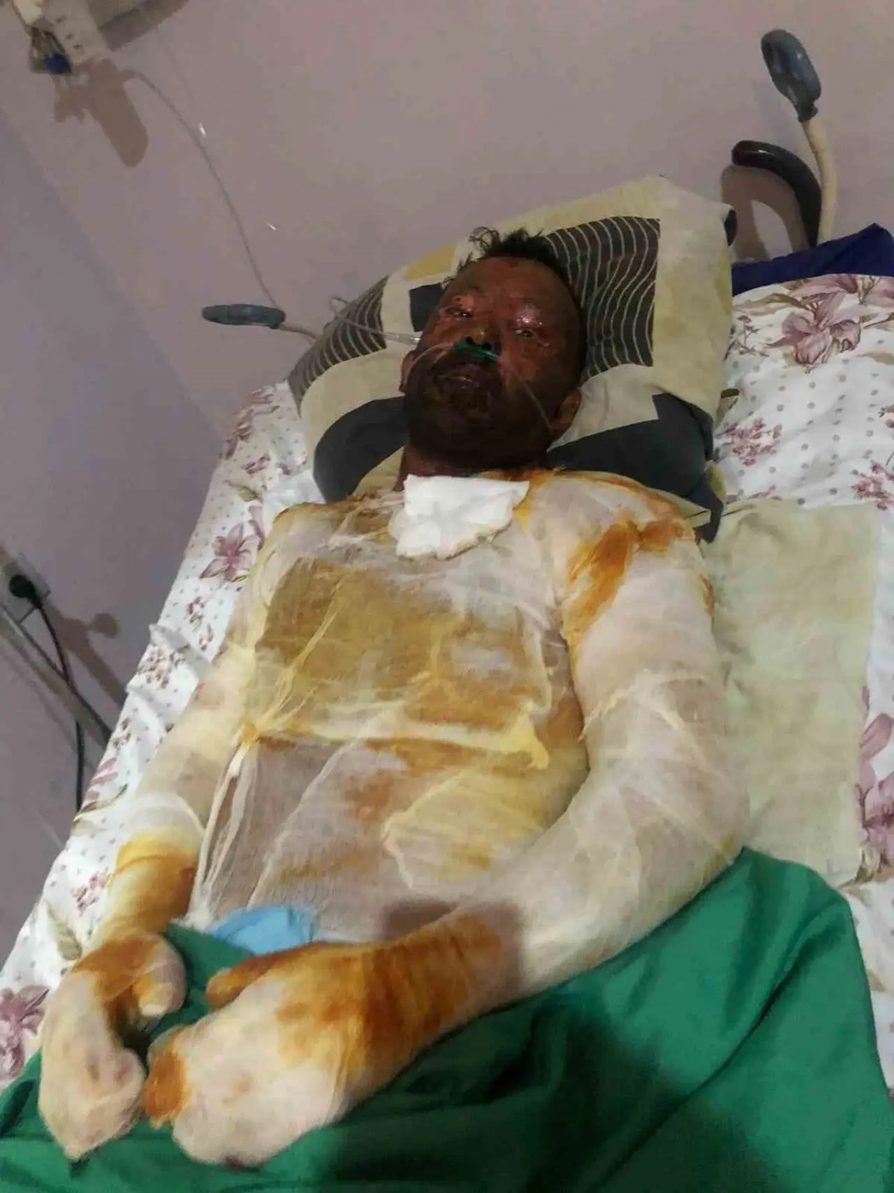 azerbaycanli-ciftin-dogal-gaz-patlamasinda-kapanan-elleri-3-yil-sonunda-eskisehirdeki-tedaviyle-kavustu