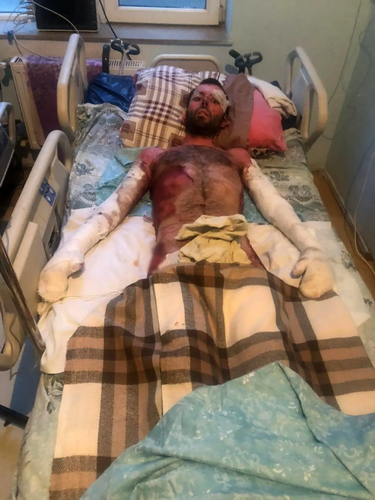 azerbaycanli-ciftin-dogal-gaz-patlamasinda-kapanan-elleri-3-yil-sonunda-eskisehirdeki-tedaviyle-kavustu