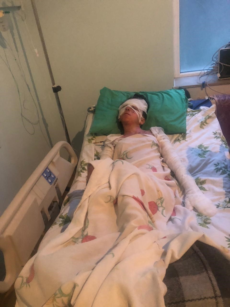 azerbaycanli-ciftin-dogal-gaz-patlamasinda-kapanan-elleri-3-yil-sonunda-eskisehirdeki-tedaviyle-kavustu